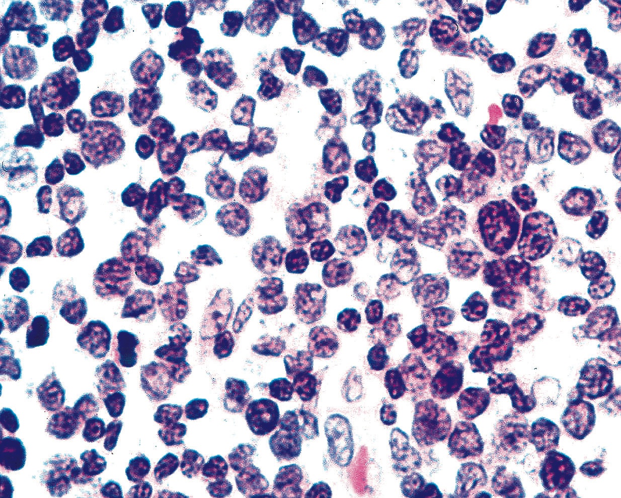 Pathology Outlines - Neuroendocrine Carcinoma